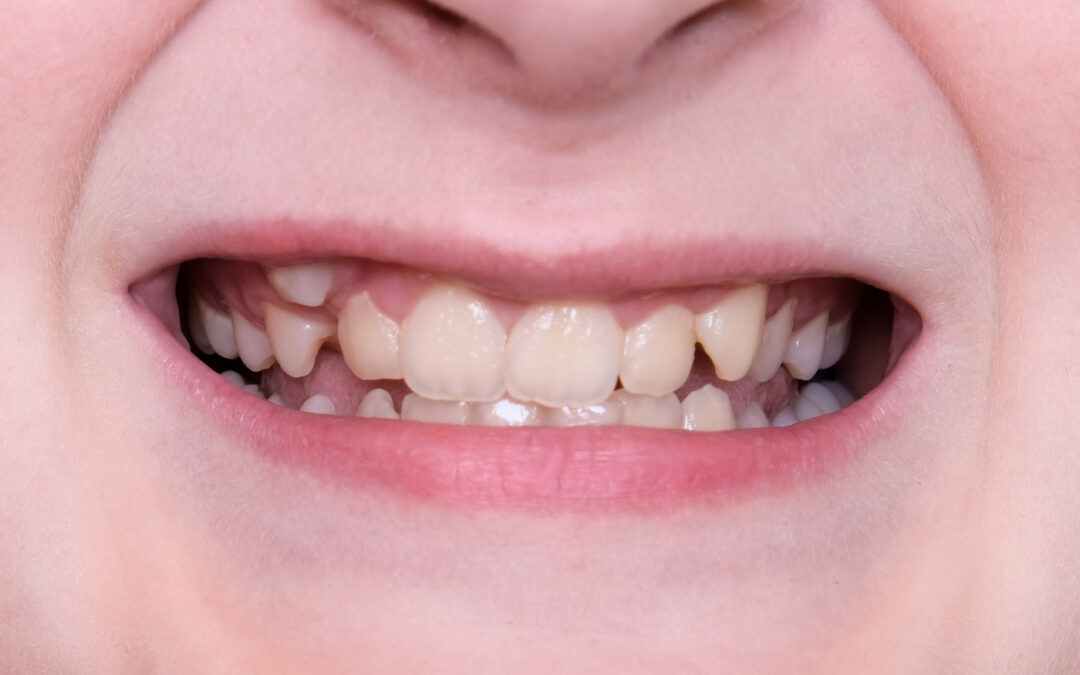 When to Start Orthodontic Treatment
