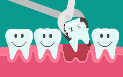 How Long Should You Wait to Exercise After a Tooth Extraction?